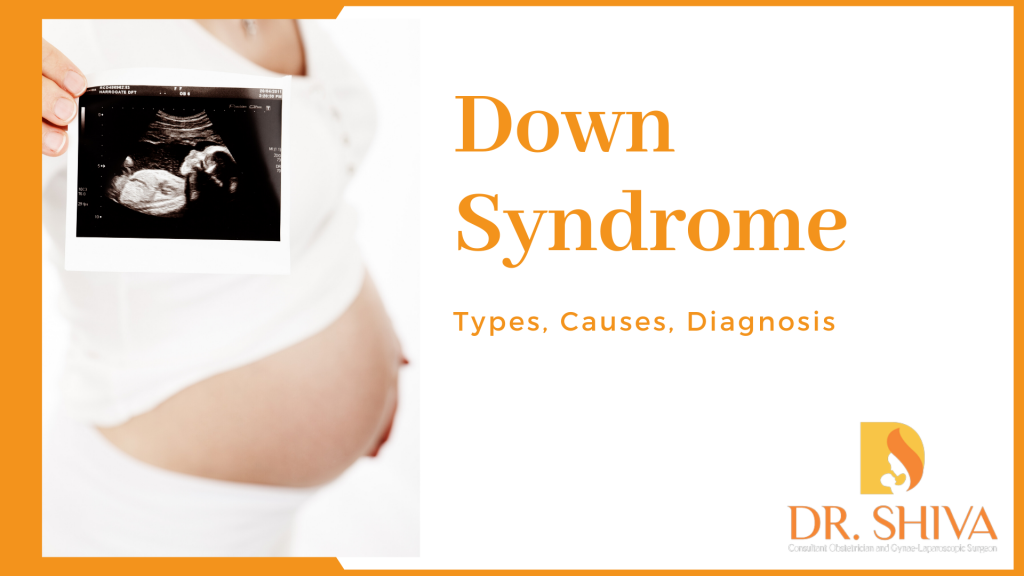 Down Syndrome Types Causes and Treatment Dr Shiva