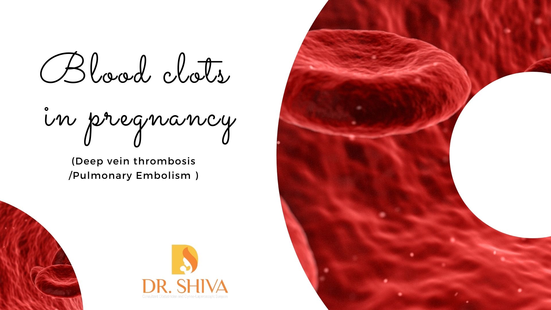 Blood Clots During Pregnancy DVT PE Blood Clots While Pregnant