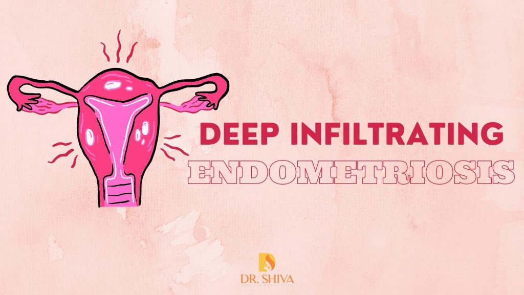 Deep Infiltrating Endometriosis Symptoms And Management 