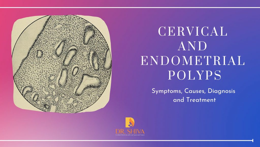 cervical-and-endometrial-polyp-cause-and-treatment