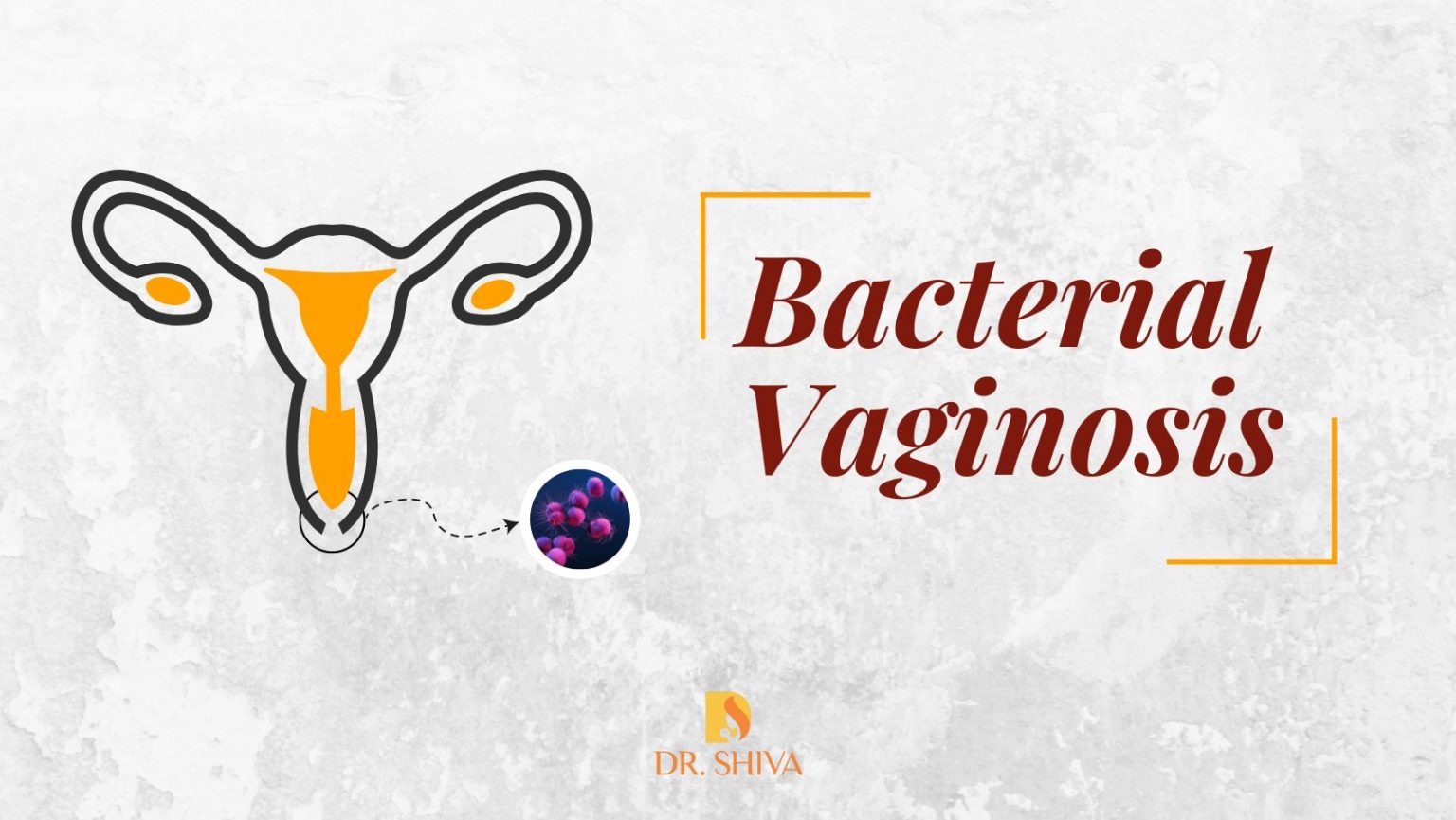 Bacterial Vaginosis | Vaginitis Infection & Treatments | BV Infection