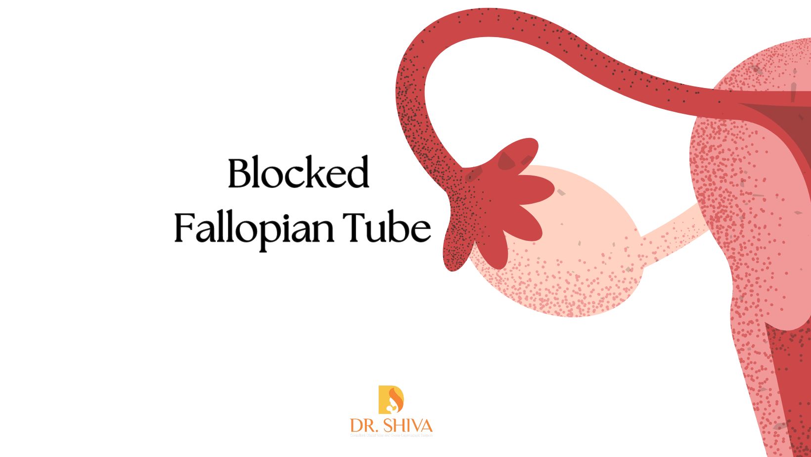 Blocked Fallopian Tubes: Understanding Causes, Diagnosis, and Treatment Options