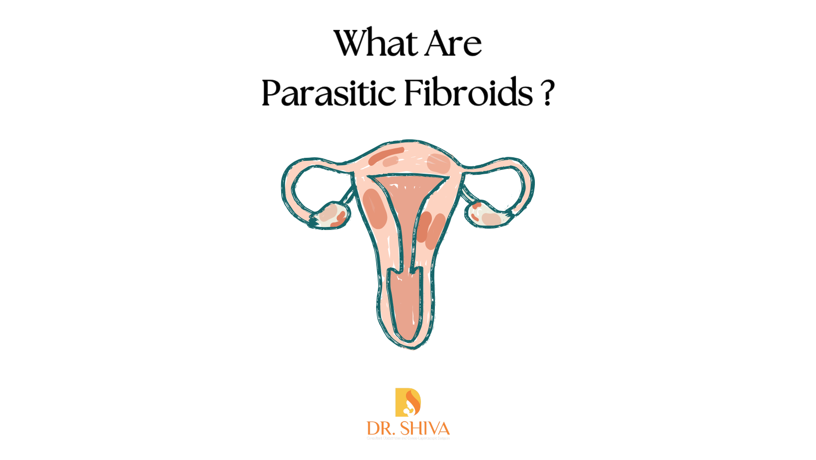 Parasitic Fibroids